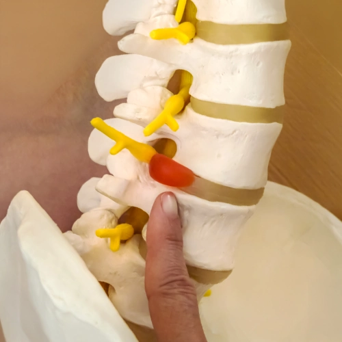 Herniated Disc Diagram